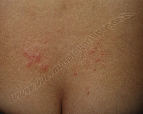 acariasi differenza tra scabbia e acariasi del corpo