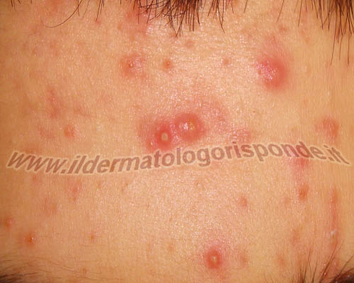 Antibiotici per purificazione di faccia e intestini