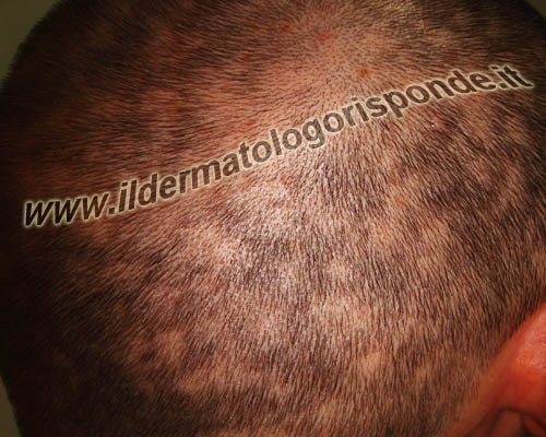 immagine di sifilide secondaria con alopecia a piccole chiazze