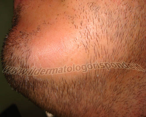 alopecia areata localizzata alla barba