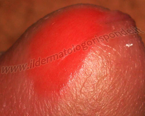 balanite plasmacellulare di Zoon balanite lichenoide e balanite plasmacellulare possono talora presentarsi con manifestazioni cliniche simili