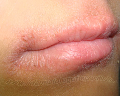 foto di dermatite atopica delle labbra e dell’area periorale