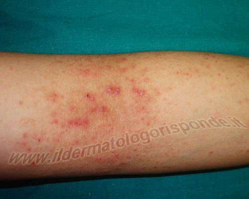 immagine di dermatite atopica localizzata alle pieghe del braccio