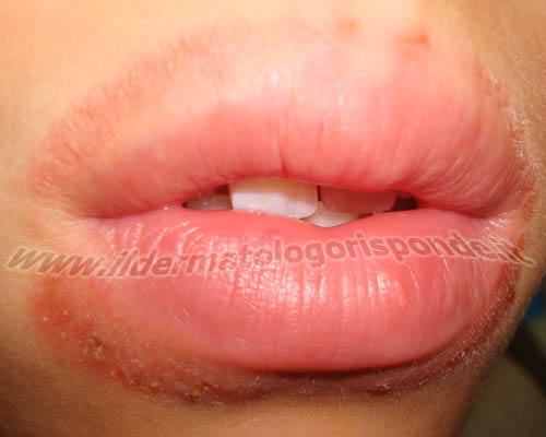 immagini di dermatite da leccamento o lip lickers dermatitis