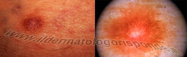 dermatofibroma lenticolare immagine dermatoscopica di dermatofibroma lenticolare benigno noto in dermatologia anche come dermatofibroma