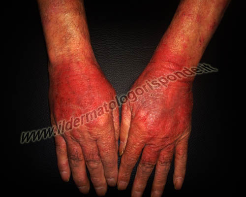foto di eczema e creme senza parabeni