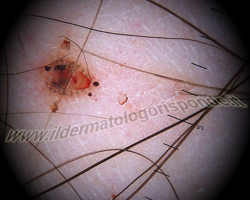 entomoscopia ricerca acaro e pediculosi della pelle mediante dermatoscopia