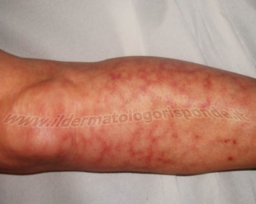 immagine di dermatite da scaldino degli arti inferiori, in seguito ad esposizione a fonte di calore