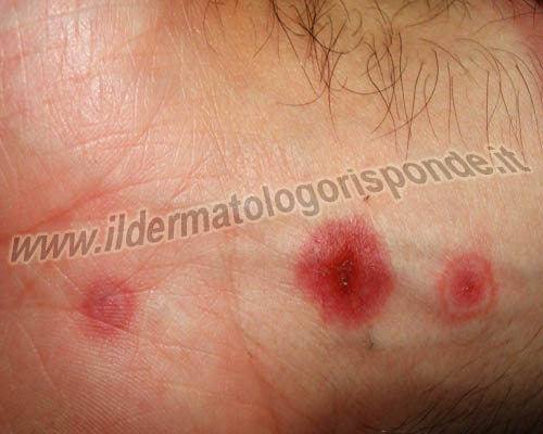 immagini di eritema polimorfo con tipiche lesioni a bersaglio