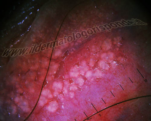 genitoscopia genitoscopia salerno dei grani di Fordyce