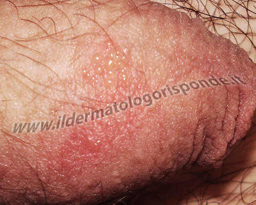 genitle herpes pictures