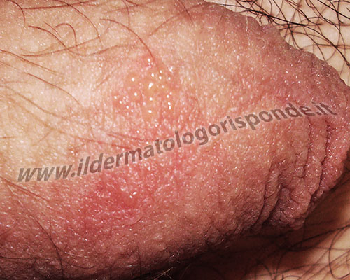 herpes genitale immagini di herpes genitale con tipiche vescicole a grappolo sull’asta del pene