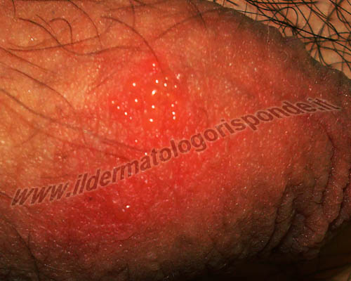 Come curare herpes genitale