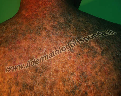 ittiosi malattie rare della pelle o con manifestazioni cliniche di interesse dermatologico
