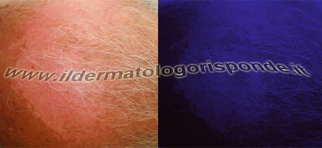 nella foto si può osservare la tipica fluorescenza biancastra in una chiazza di vitiligine del cuoio capelluto