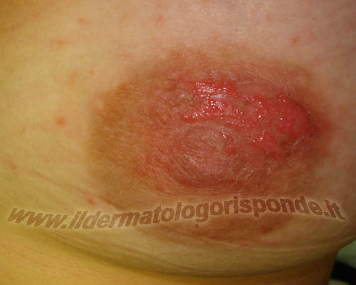Eczema Areola Photo - Skin Disease Pictures