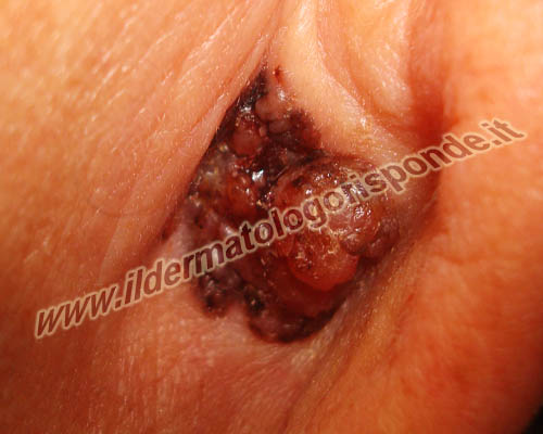 immagine di melanoma dell’orecchio localizzato alla regione retroauricolare