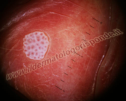 pattern vascolare punteggiato alla penoscopia in paziente affetto da infezione da HPV