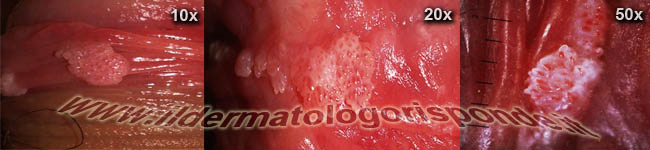 immagini di condilomi osservati in genitoscopia o mediante penoscopia
