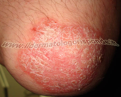 Se ci può essere psoriasi al bambino 2 anni