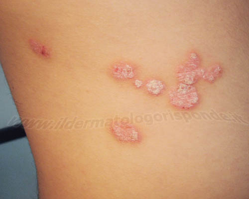 Quali rimedi di gente da eczema