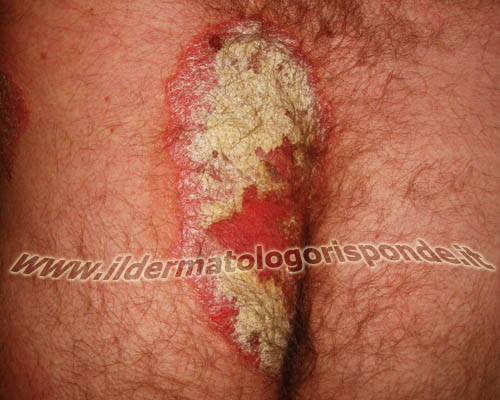psoriasi_glutei