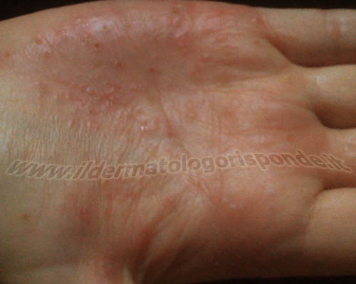 psoriasi_pustolosa