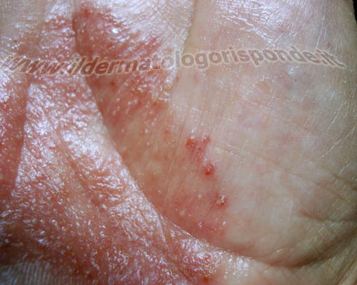 psoriasi_mani