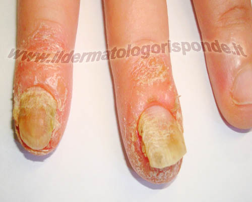 Cura di Alakol di psoriasi