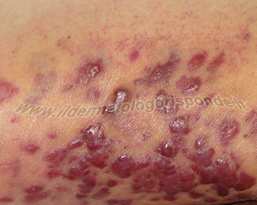 foto del sarcoma di kaposi e infezioni da micoplasmi