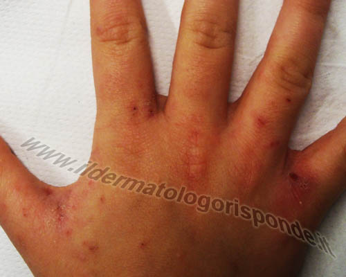 scabbia immagini di scabbia localizzata alle mani