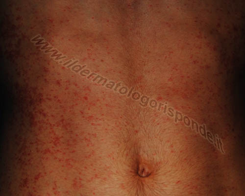 scabbia la scabbia e altre malattie della pelle caratterizzate da prurito intenso che aumenta di sera
