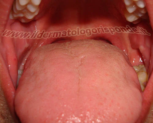 immagini della sindrome della bocca urente