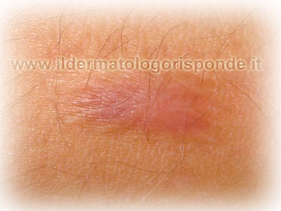asportazione cheloide