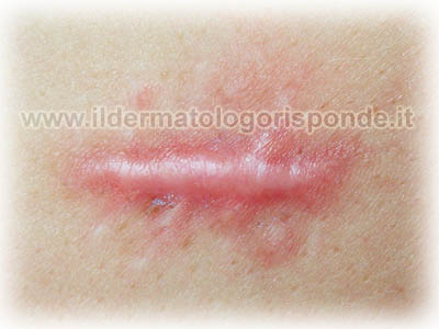 cheloide crioterapia