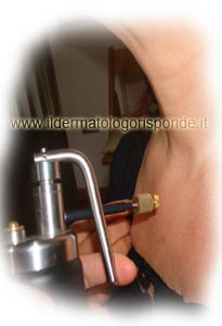 crioterapia curettage