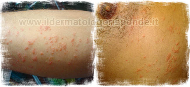 dermatite in campania a salerno e napoli