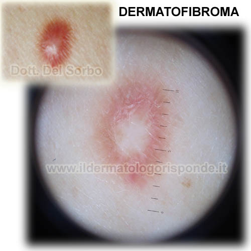 dermatofibroma lenticolare istiocitoma