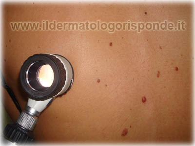 Dermatoscopia_Mappatura_dei_Nei