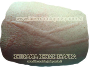 Orticaria Dermografica e Dermografismo positivo
