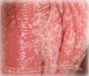 balanopostite_candida