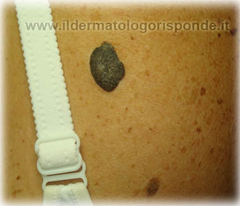 curettage azoto liquido
