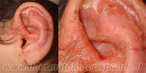 dermatite orecchie