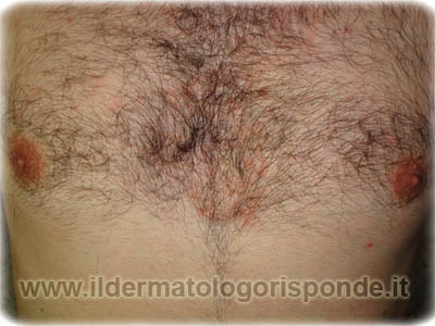 dermatite seborroica salerno