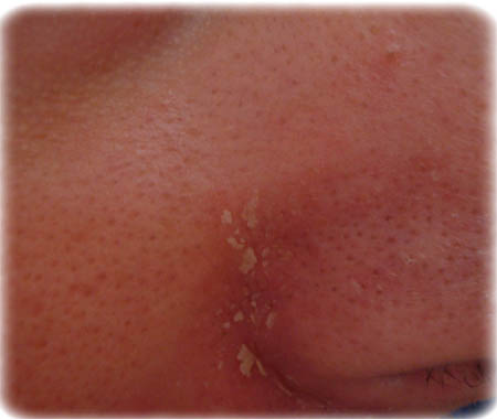 dermatite_seborroica_napoli