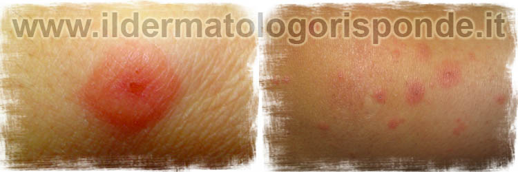 eritema_polimorfo_napoli