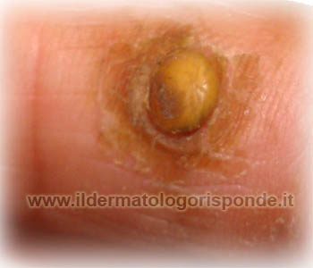 fibroma napoli