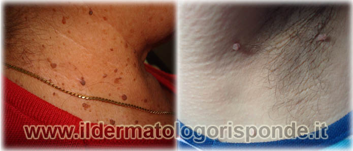 fibromi penduli salerno