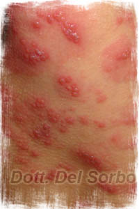 herpes salerno