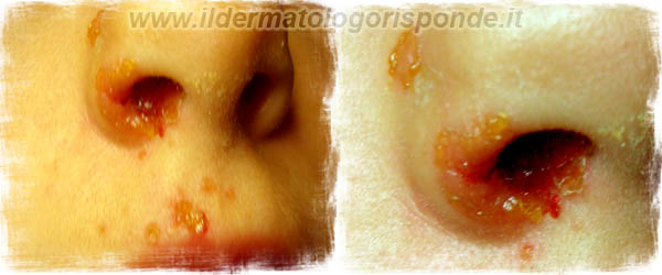 impetigine_contagiosa